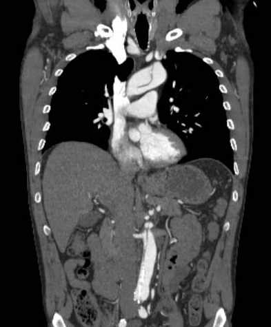 File:Aortic dissection - Stanford type B (Radiopaedia 73648-84437 B 54).jpg
