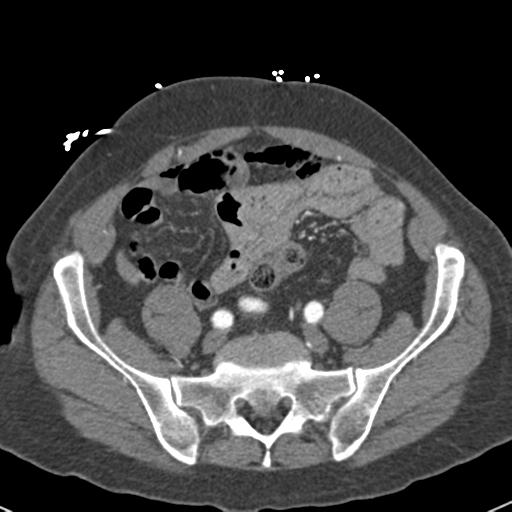 Aortic intramural hematoma (Radiopaedia 31139-31838 B 136).jpg