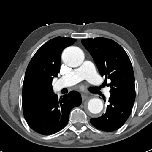 Aortic intramural hematoma (Radiopaedia 31139-31838 B 42).jpg