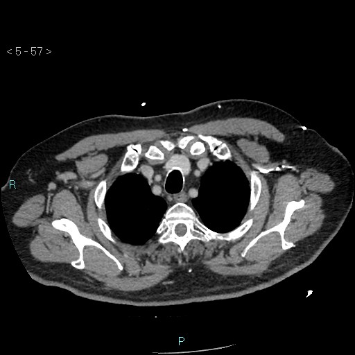 Aortic intramural hematoma (Radiopaedia 48463-53380 C 27).jpg
