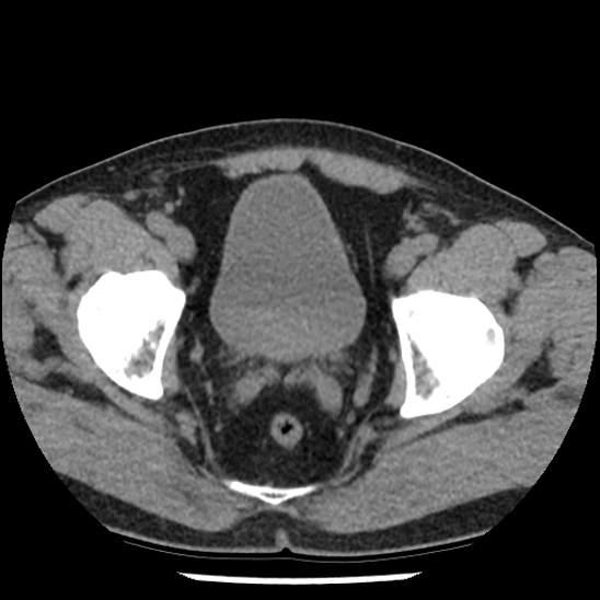 Aortic intramural hematoma (type B) (Radiopaedia 79323-92387 Axial non-contrast 107).jpg