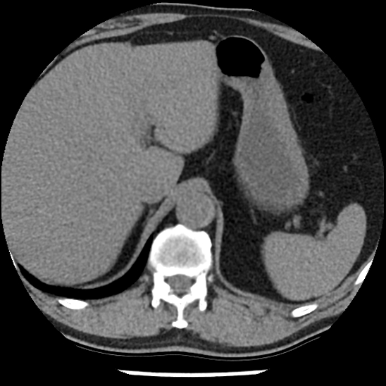 Aortic intramural hematoma (type B) (Radiopaedia 79323-92387 Axial non-contrast 52).jpg