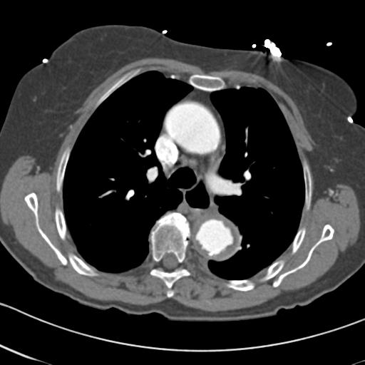 Aortic intramural hematoma from penetrating atherosclerotic ulcer (Radiopaedia 31137-31836 A 29).jpg