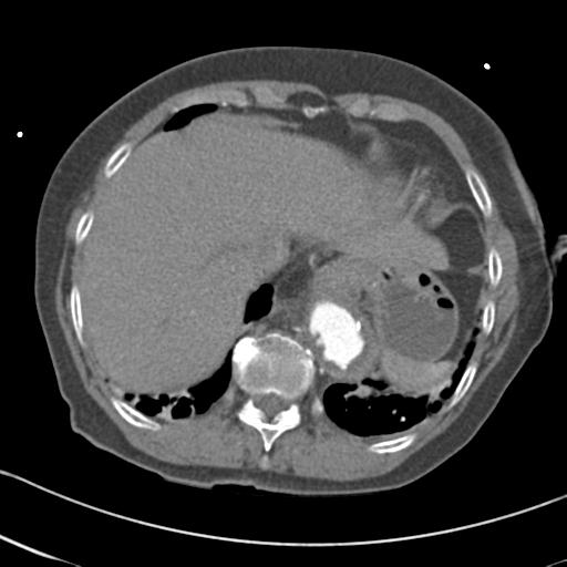 Aortic intramural hematoma from penetrating atherosclerotic ulcer (Radiopaedia 31137-31836 A 66).jpg