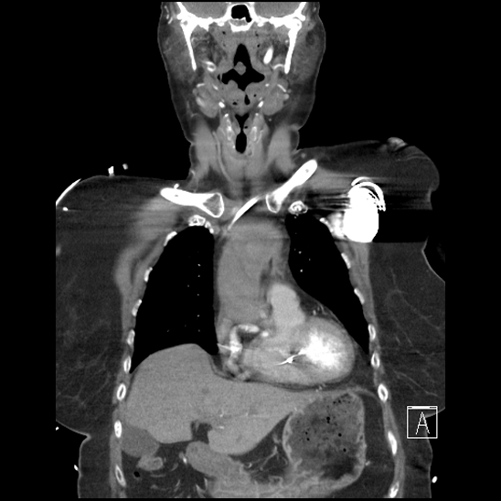 Aortic intramural hematoma with dissection and intramural blood pool (Radiopaedia 77373-89491 C 15).jpg
