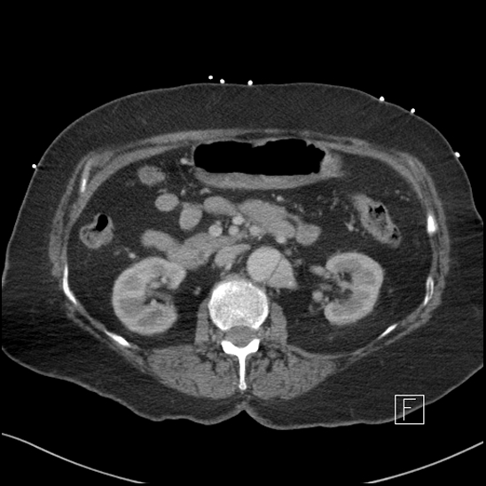 Aortic intramural hematoma with dissection and intramural blood pool (Radiopaedia 77373-89491 E 28).jpg