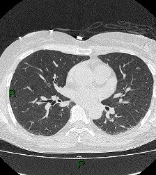 File:Aortic valve endocarditis (Radiopaedia 87209-103485 Axial lung window 55).jpg