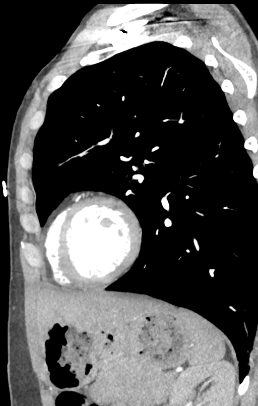 Aortic valve non-coronary cusp thrombus (Radiopaedia 55661-62189 C+ arterial phase 11).png