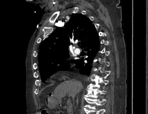 Aortoesophageal fistula with endovascular repair (Radiopaedia 73781-84592 Sagittal C+ CTPA 77).jpg