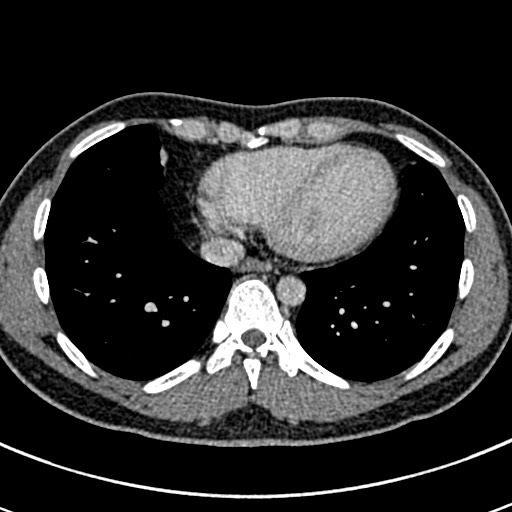 Apical lung mass mimic - neurogenic tumor (Radiopaedia 59918-67521 A 59).jpg
