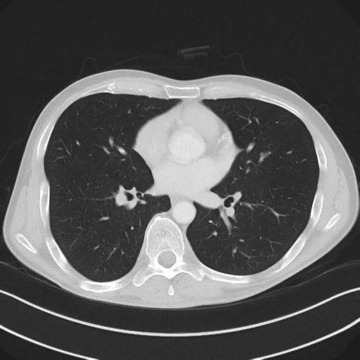 Apical pleural calcification (Radiopaedia 46141-50499 Axial lung window 39).png