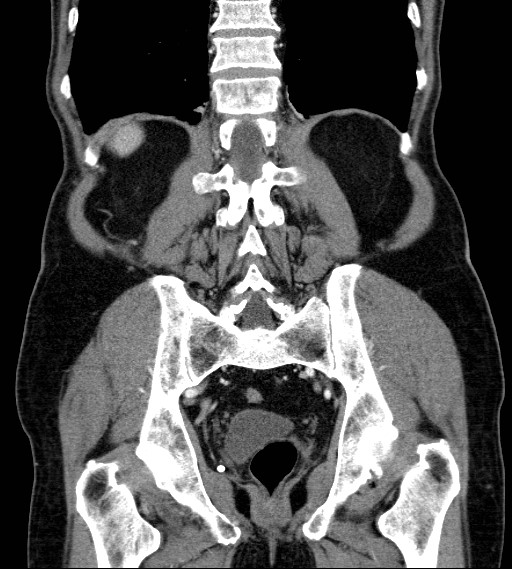 Appendiceal adenocarcinoma complicated by retroperitoneal abscess (Radiopaedia 58007-65039 A 66).jpg