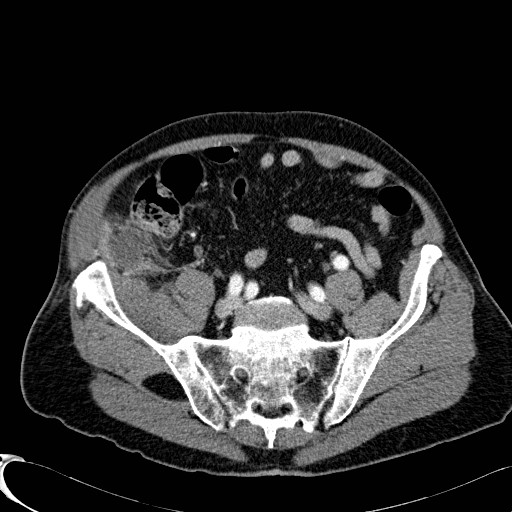 File:Appendiceal adenocarcinoma complicated by retroperitoneal abscess (Radiopaedia 58007-65039 B 105).jpg