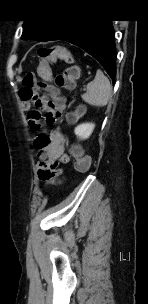 Appendiceal hemorrhage (Radiopaedia 70830-81025 Sagittal C+ delayed 91).jpg