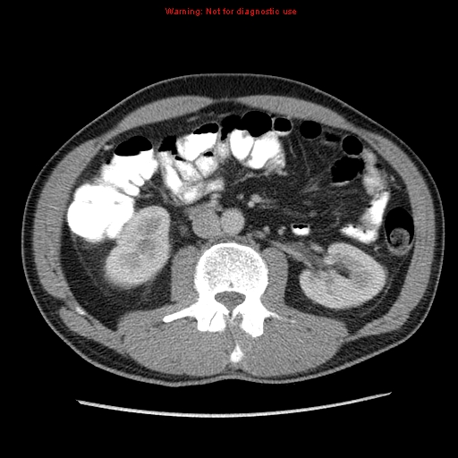 File:Appendicitis and renal cell carcinoma (Radiopaedia 17063-16760 A 27).jpg