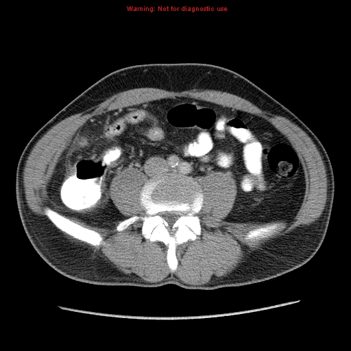 Appendicitis and renal cell carcinoma (Radiopaedia 17063-16760 A 36).jpg