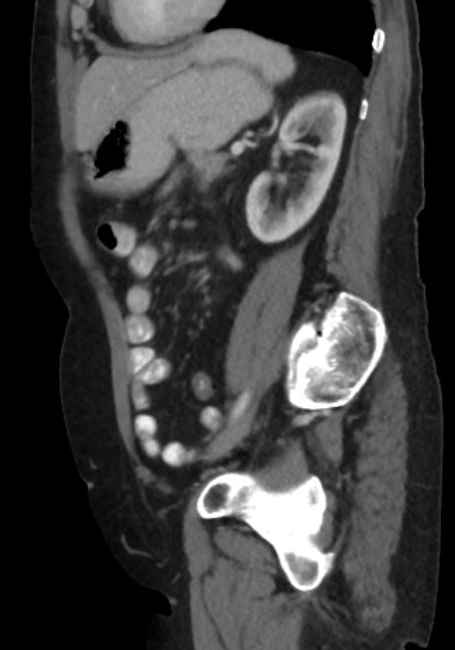 Appendicitis due to chicken fibula (Radiopaedia 74314-85198 C 70).jpg