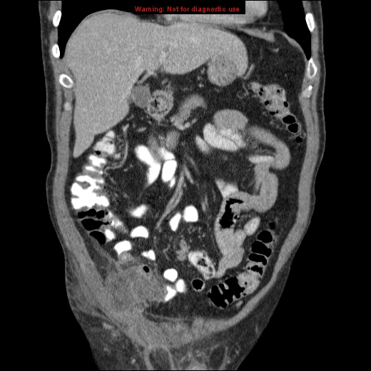 File:Appendicitis mass in inguinal hernia (Radiopaedia 26858-27029 B 21).jpg