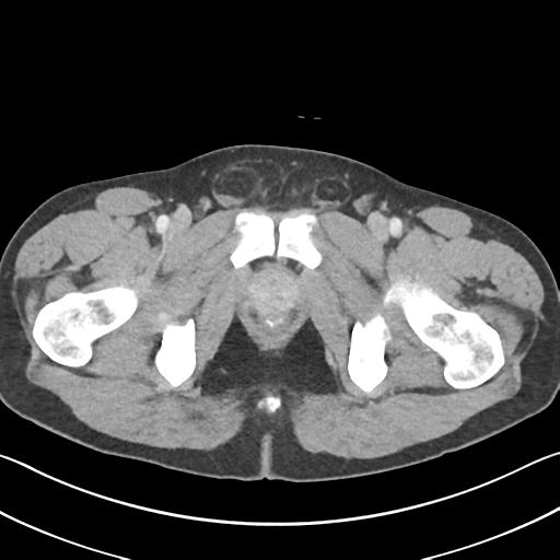 File:Appendicitis with cecal bar sign (Radiopaedia 31878-32830 B 83).jpg