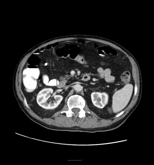 Appendicitis with localized perforation and abscess formation (Radiopaedia 49035-54130 A 37).jpg