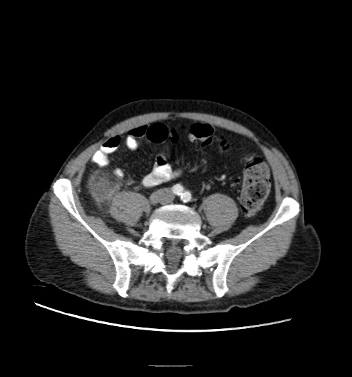 Appendicitis with localized perforation and abscess formation (Radiopaedia 49035-54130 A 62).jpg