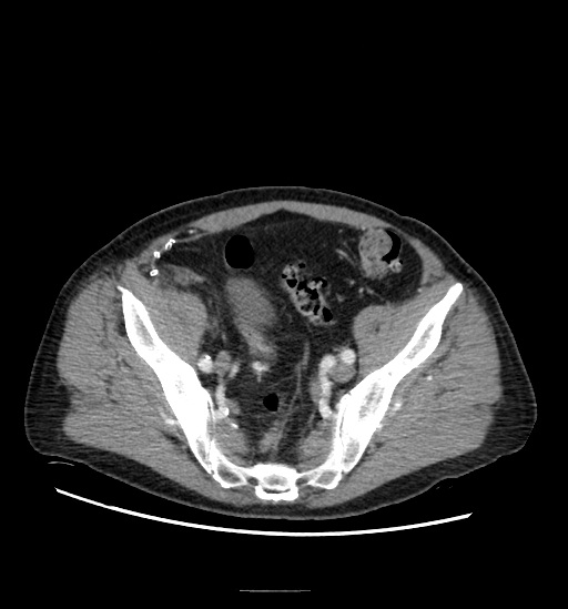 Appendicitis with localized perforation and abscess formation (Radiopaedia 49035-54130 A 71).jpg