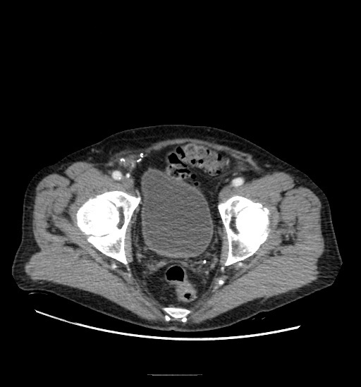 File:Appendicitis with localized perforation and abscess formation (Radiopaedia 49035-54130 A 79).jpg