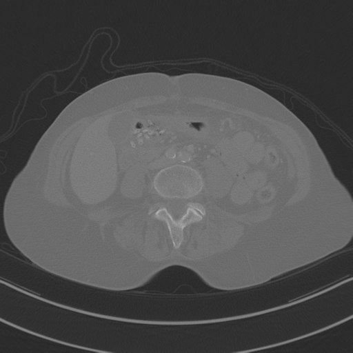 April fools' 2019- calcified peritoneal arachnoidosis (Radiopaedia 67273-76636 Axial bone window 25).png