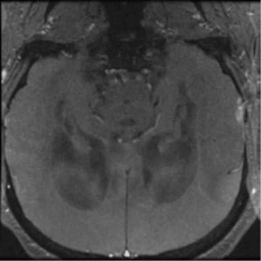 File:Aqueduct stenosis with corpus callosum hypoattenuation post shunting (Radiopaedia 37212-38969 Axial CSF Flow 44).png