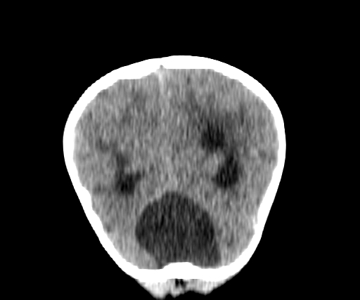 Arachnoid cyst-posterior fossa (Radiopaedia 88661-105370 Coronal non-contrast 64).jpg