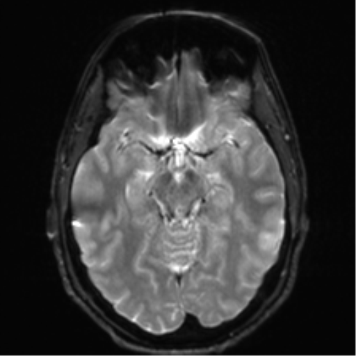 Arachnoid cyst - cerebellopontine angle (Radiopaedia 59689-67083 Axial DWI 15).png