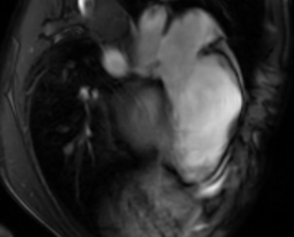 Arrhythmogenic right ventricular cardiomyopathy (Radiopaedia 69564-79464 4ch cine 106).jpg