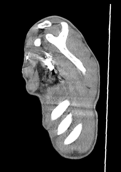 Arrow injury in the neck (Radiopaedia 75268-86390 G 23).jpg
