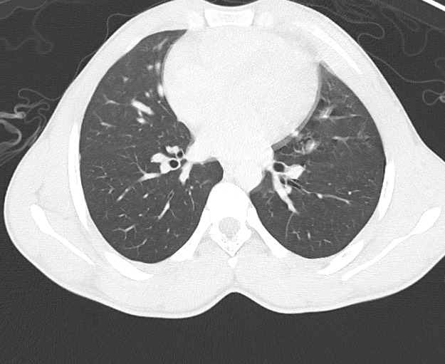 Arrow injury to the chest (Radiopaedia 75223-86321 Axial lung window 46).jpg