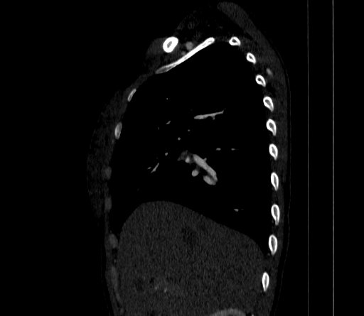 Arteria lusoria (Radiopaedia 88528-105192 C 34).jpg