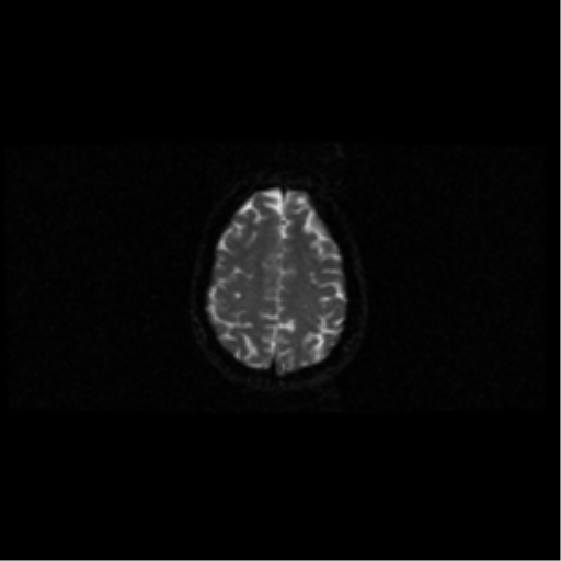 File:Arteriovenous malformation (cerebral) (Radiopaedia 40070-42580 Axial DWI 40).png