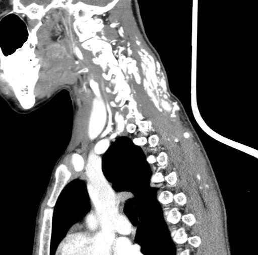 Arteriovenous malformation of the neck (Radiopaedia 53935-60062 C 47).jpg