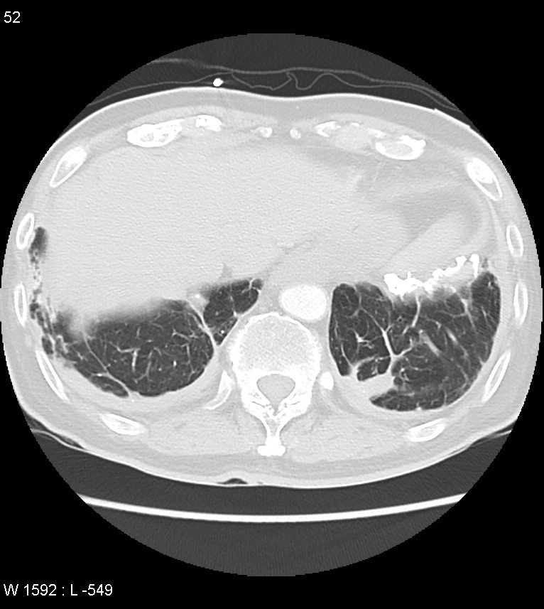 Asbestos related lung and pleural disease (Radiopaedia 14377-14301 A 49).jpg