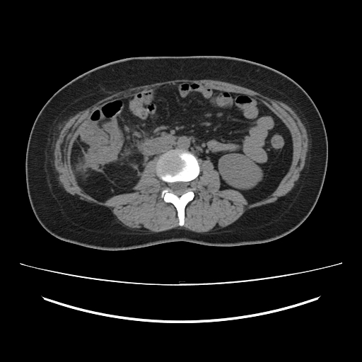 File:Ascending retrocecal appendicitis with liver abscesses (Radiopaedia 60066-67615 Axial non-contrast 44).jpg