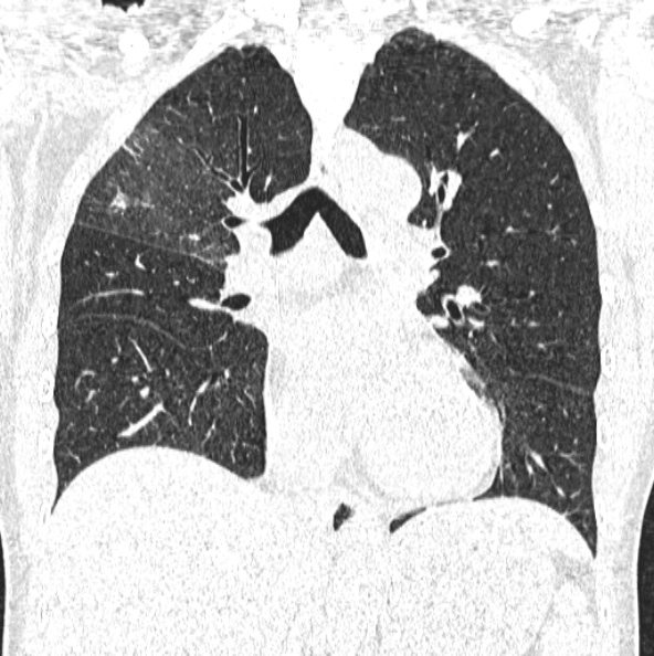 File:Aspergilloma (Radiopaedia 26223-26347 Coronal lung window 27).jpg