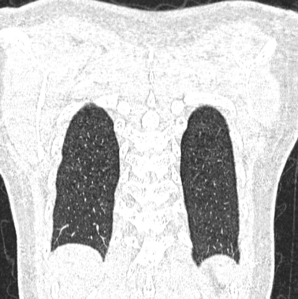 File:Aspergilloma (Radiopaedia 26223-26347 Coronal lung window 48).jpg
