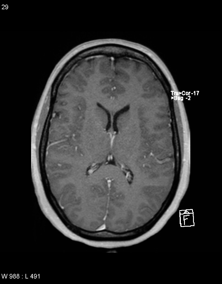 Astroblastoma (Radiopaedia 39792-42217 Axial T1 C+ 28).jpg