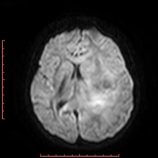 Astroblastoma (Radiopaedia 74287-85162 Axial DWI 59).jpg