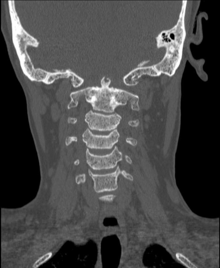 Atlanto-occipital assimilation with basilar invagination (Radiopaedia 70122-80188 Coronal bone window 103).jpg
