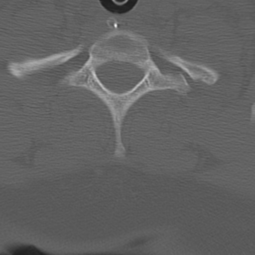 Atlanto-occipital dissociation (Radiopaedia 33848-35013 Axial bone window 43).png
