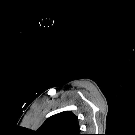 File:Atlanto-occipital dissociation (Traynelis type 1), C2 teardrop fracture, C6-7 facet joint dislocation (Radiopaedia 87655-104061 D 88).jpg