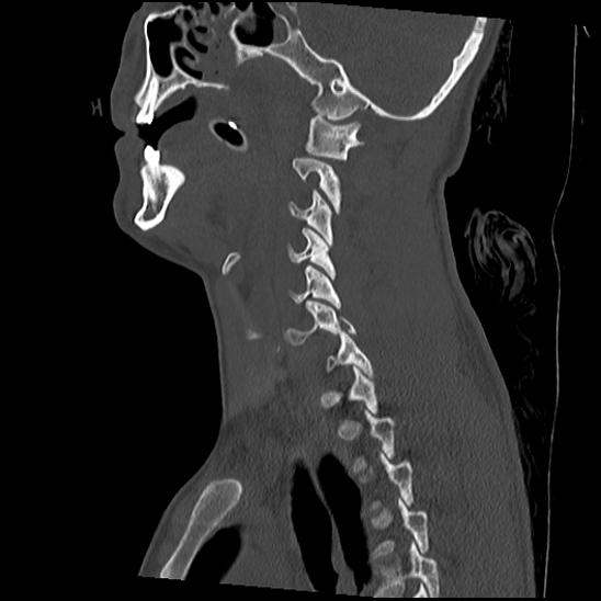 Atlanto-occipital dissociation (Traynelis type 1), C2 teardrop fracture, C6-7 facet joint dislocation (Radiopaedia 87655-104061 Sagittal bone window 27).jpg