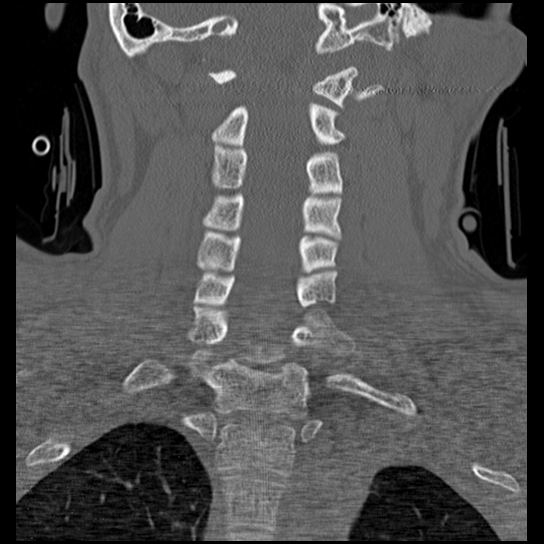 Atlanto-occipital dissociation injury (Radiopaedia 29274-29698 Coronal bone window 22).png