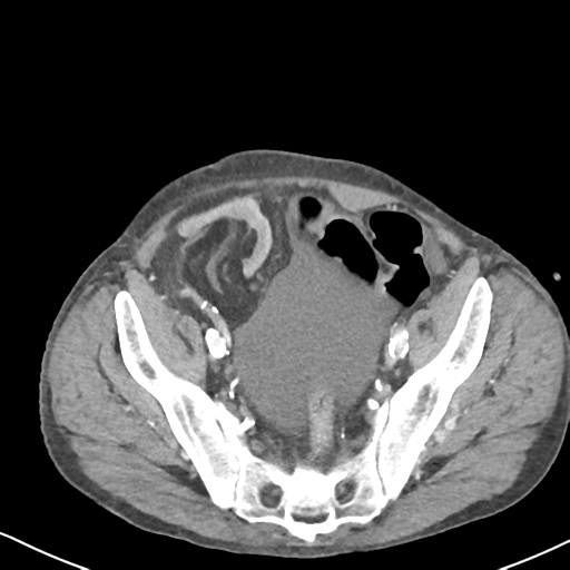 Atraumatic splenic rupture (Radiopaedia 42931-46160 A 70).png