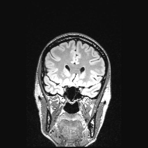 File:Atretic encephalocoele with inferior vermis hypoplasia (Radiopaedia 30443-31108 Coronal FLAIR 126).jpg